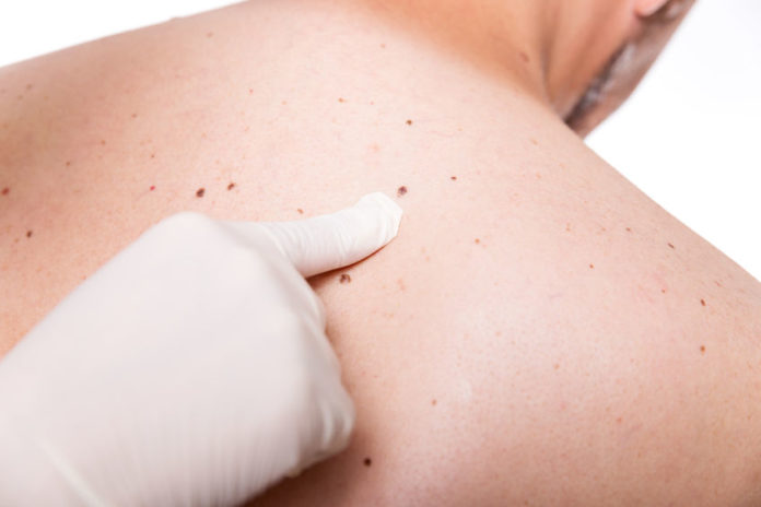 Du 20 au 24 mai : semaine du dépistage du cancer de la peau - crédit photo : 123 RF Du 20 au 24 mai : semaine du dépistage du cancer de la peau