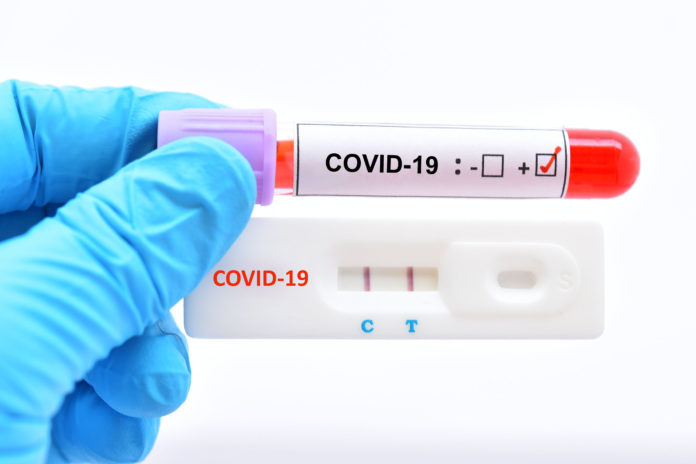tests de sérologie pour le covid-19 123RF©