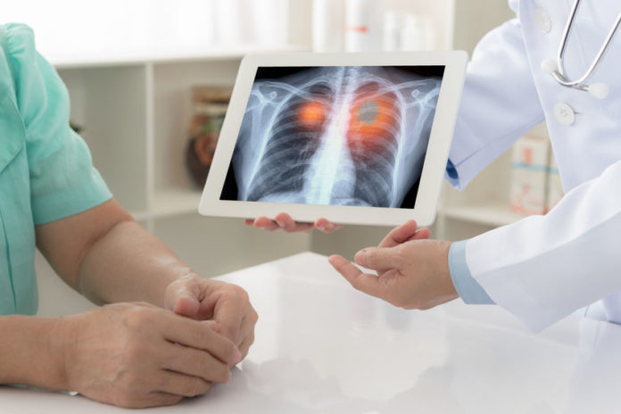 Un médecin informe sa patiente que le cancer du poumon
